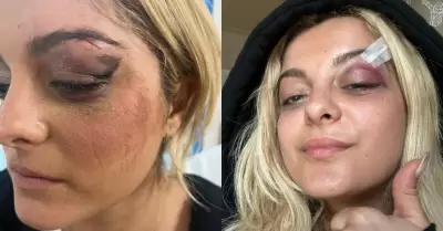 Bebe Rexha sufri una lesin en el ojo.