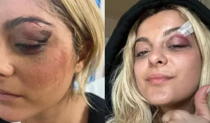 Bebe Rexha sufri una lesin en el ojo.