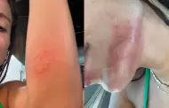 Anitta revela que sufri� un ataque de medusas en Ibiza