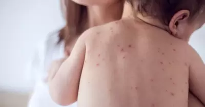 sarampi�n