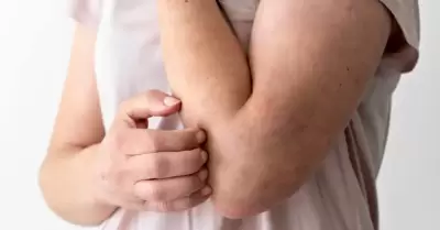 sarampi�n
