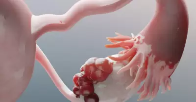 C�ncer de Ovario