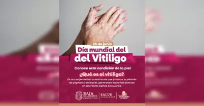 Vit�ligo