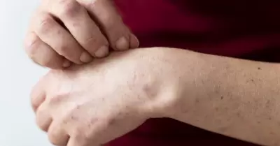 Sarampi�n