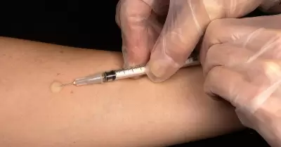 vacunaci�n, prueba de la tuberculina, diagn�stico, tuberculosis, vacuna contra l