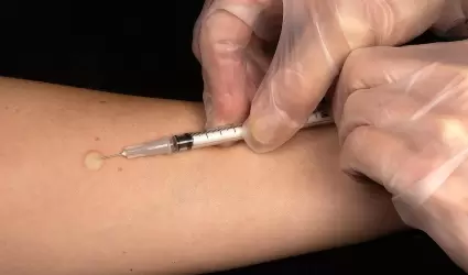 vacunaci�n, prueba de la tuberculina, diagn�stico, tuberculosis, vacuna contra l