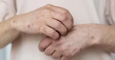 sarampi�n